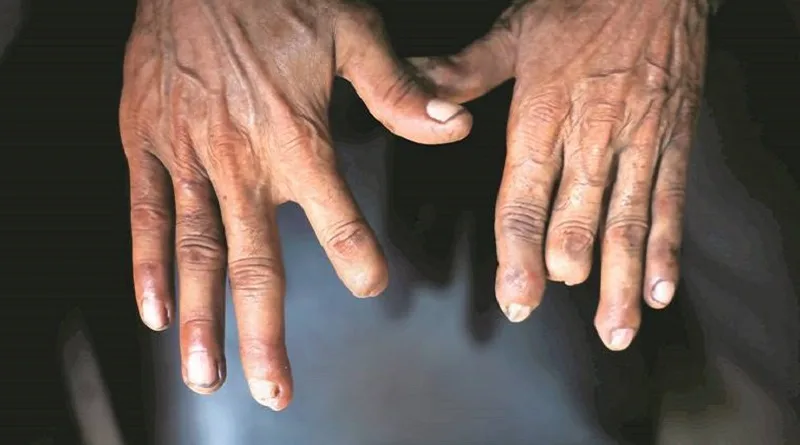 मानेसर-गुड़गांव ऑटो सेक्टर में हाथ गंवाते, अपंग होते मज़दूरों की दास्तान- ग्राउंड रिपोर्ट